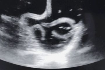Mengatasi Infeksi Cacing Kremi, Pada Perempuan Bisa Sebabkan Vaginitis juga Endrometriosis