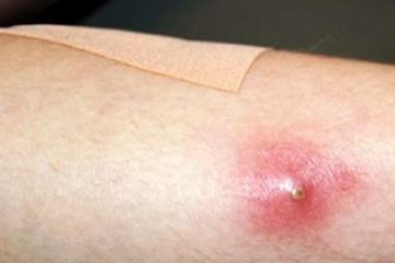6 Obat Bisul Alami yang Aman Digunakan di Rumah, Dijamin Benjolan Cepat kempes