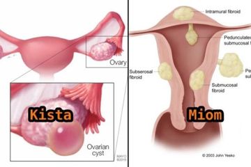 Perbdaan kista dan miom, gangguan tumor jinak pada organ reproduksi wanita.