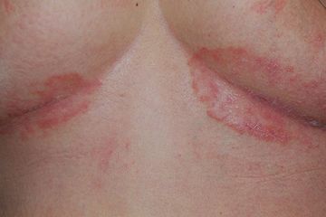 Sternoclavicular disjunction psoriasis kezelése