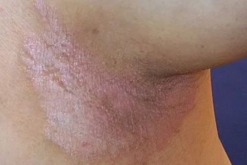 Psoriasis pada Perempuan, Seperti Dialami Indadari Mantan Istri Lucky Hakim dan Caisar YKS Menderita