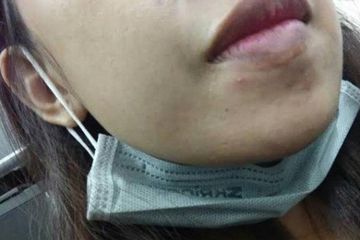 Budaya Menggunakan Masker di Masa Pandemi Membuat Kasus Masalah Kulit Wajah Meningkat