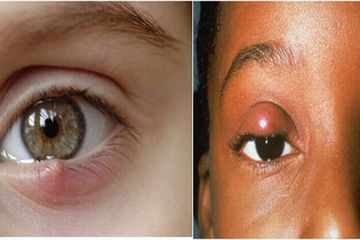 Kiri, bintitan. Kanan, Chalazion.