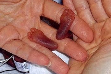 Telah Lahir Bayi Terkecil di Dunia, Lebih Kecil dari Telur Ayam, Panjang 25cm Berat 280 gram