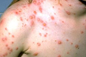 Pengobatan Herpes Zoster, Pemberian Antivirus dan Obat Pereda Nyeri