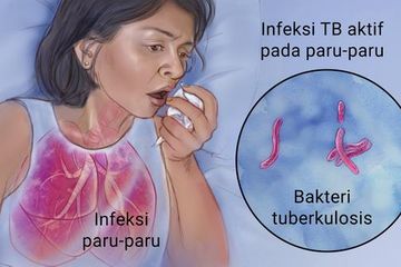 Infeksi TBC aktif pada paru-paru
