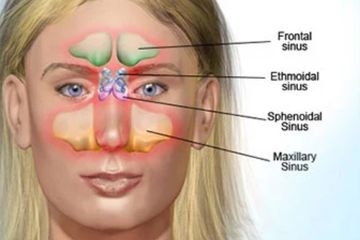 Penyakit infeksi hidung sinisitis.