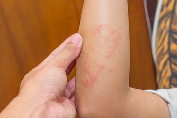 Infeksi jamur dapat memengaruhi tangan, mulut, alat kelamin, dan area lain di tubuh.