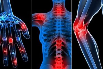 3 Metode Pengobatan Rematik alias Rheumatoid Arthritis Direkomendasikan