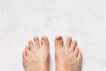 Ulkus diabetikum, penyakit infeksi kaki diabetes.