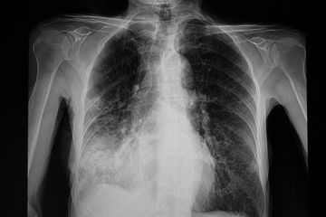 Penampakan rontgen penyakit infeksi pneumonia.