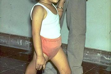 Gejala Infeksi Polio, Penyakit yang Menyebabkan Kelumpuhan Permanen