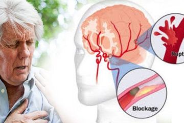 Mengenali tanda awal stroke berupa FAST dapat mencegah cacat permanen bahkan kematian.
