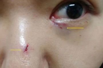 Seorang Wanita Pergi Ke Rumah Sakit Setelah Alami Luka Di Sekitar Hidung Dan Mata Dokter Memeriksa Dan Kaget Saat Tahu Ada Benda Ini Yang Tersangkut Di Dalam Tengkorak Pasiennya Semua Halaman
