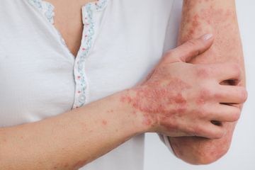 Manfaat Tak Terduga Vitamin D Bagi Pengidap Penyakit Psoriasis!
