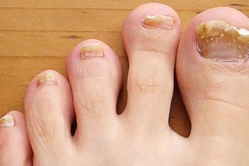 Cara Mengobati Penyakit Infeksi Jamur Kuku Kaki Onikomikosis