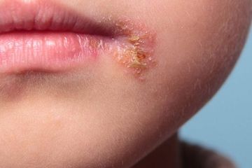 Impetigo, Infeksi Kulit Menular Pada Anak, Begini Cara Mencegahnya