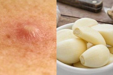 Jangan Tunggu Bisul Masak Baru Nak Picit Doktor Ini Dedahkan Risikonya