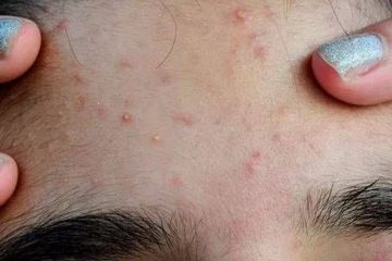  Cukup Pakai 6 Bahan Alami Ini Pada Wajah Untuk Mengatasi Beruntusan