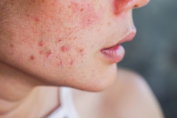 Inilah kosmetik yang dianjurkan untuk mereka yang berjerawat.
