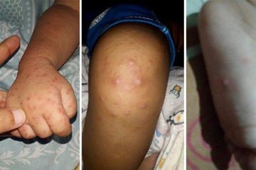Flu Singapura juga dikenal sebagai penyakit tangan, kaki dan mulut (Hand-Foot-Mouth-Disease).