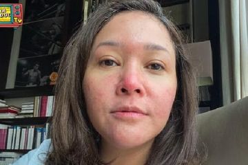 Maia Estianty mengalami penyakit kulit rosacea