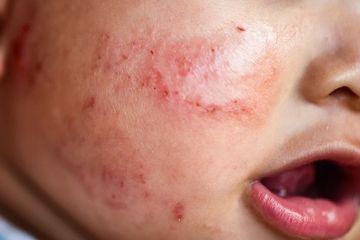 Eksim Basah pada Bayi Bisa Sebabkan Lepuhan pada Kulit, Gejalanya Bintik atau Benjolan Kecil