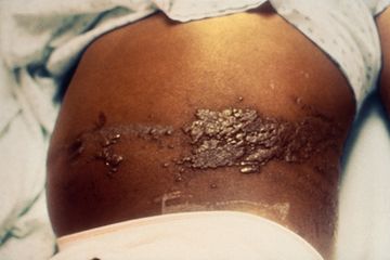 Cacar api yang disebabkan oleh virus herpes