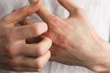 Agar Dermatitis Atopik Tidak Menjadi Infeksi, Eksim Walau Tak Berbahaya Perlu Diobati 