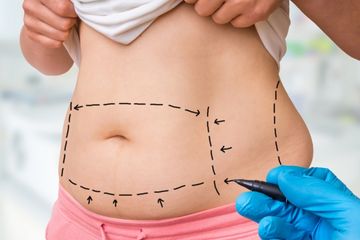 Pesan Shahnaz Haque Bagi yang Ingin Melakukan Liposuction dan Tummy Tuck, Risiko dan Komplikasinya Tidak Ringan
