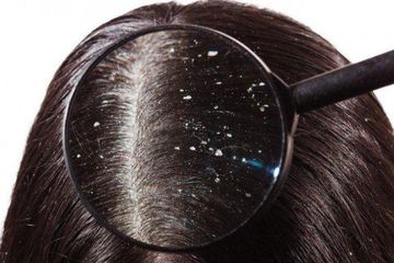 Rambut Berketombe bisa diatasi dengan bahan alami.
