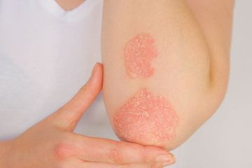 Hari Psoriasis Sedunia 2021, Covid-19 Bisa Lebih Berbahaya Bagi Pasien Psoriasis