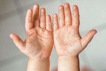 Bintik merah tanda penyakit tangan, kaki, dan mulut.