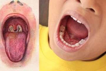 Pengobatan Diphtheria, salah satu penyakit infeksi bakteri. 