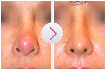 Seorang aryis cantik terkenal kapok implan hidung dan sarankan masyarakat tak melakukannya. (foto ilustrasi)