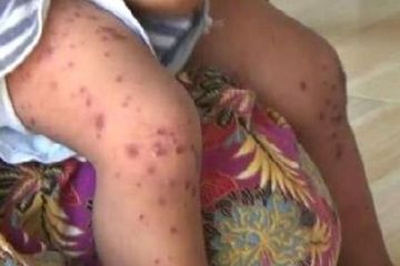 Flu Singapura lebih sering menyerang anak. Waspadai gejalanya.
