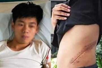Jual Ginjal Demi iPhone, Sekarang Malah Harus Sering Cuci Darah