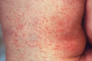Mengenal Gejala Tampek, Infeksi Virus Yang Sebabkan Munculnya Ruam Kemerahan Pada Kulit