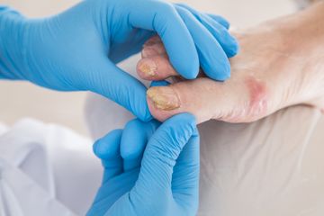 Infeksi jamur kaki pada penyandang diabetes perlu dirawat khusus.