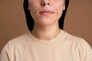 Udara lembab menimbulkan jerawat di area yang tertutup masker.