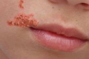 Luka Borok Bisa Jadi Pertanda Penyakit Infeksi Impetigo, Begini Cara Mengobatinya