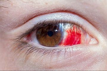 salah mengejan saat melahirkan bisa membuat retina mata robek.