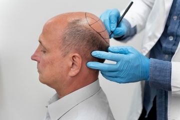 Transplantasi Rambut untuk Atasi Kebotakan, Bisa Dilakukan Usia Berapa?