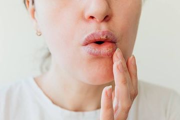 5 Penyebab Bibir Bengkak Saat Bangun Tidur, Bukan Cuma Alergi