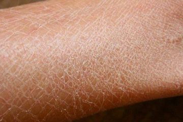 Gejala Iktiosis Vulgaris, Kulit Bersisik Seperti Kulit Ikan Akibat Gen yang Salah