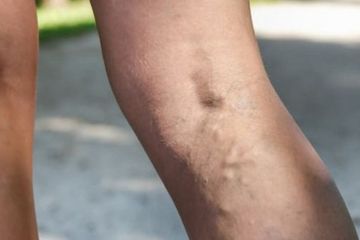 Healthy Move, Latihan Intensitas Tinggi Bisa Mengatasi Arteri Perifer