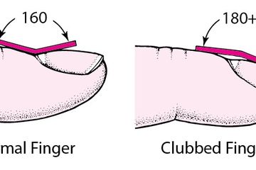 Trigger Finger dan  Clubbing Finger, Sebuah Gejala Penyakit Berat