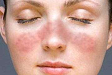 Penyakit lupus yang berpuasa penting untuk memerhatikan asupan nutrisi saat sahur maupun berbuka.