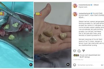 13 Ciri Perempuan yang Paling Berisiko Mengalami Penyakit Batu Empedu