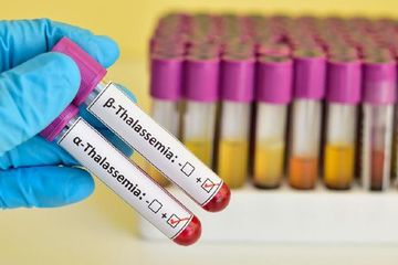 Pentingnya skrining thalassemia untuk mekan jumlah kasus thalassemia di Indonesia.